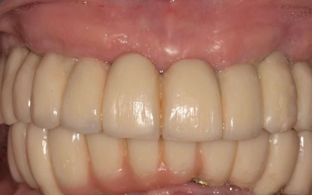 Implantologia Dentale A Napoli